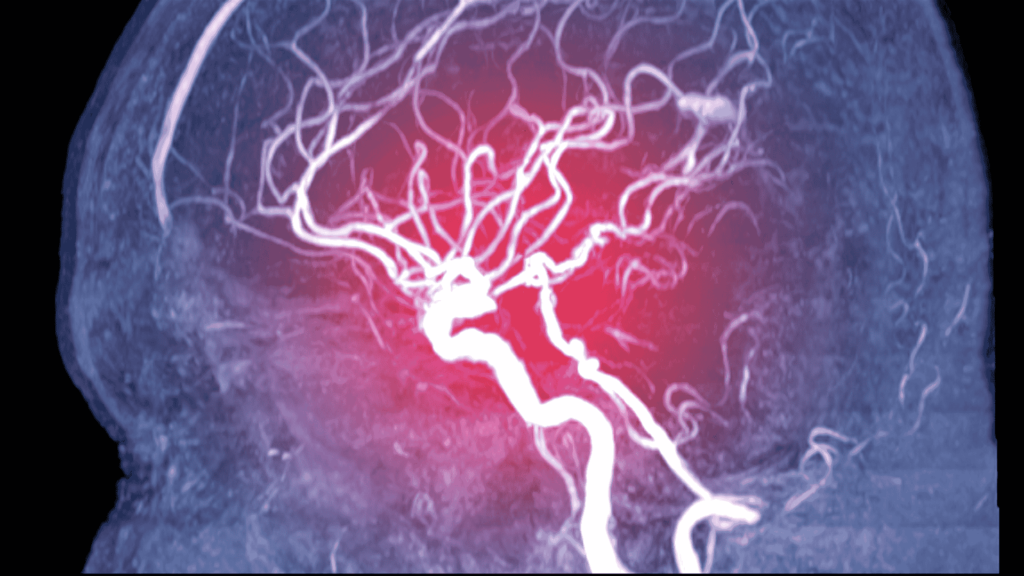 Aneurisma da Aorta Abdominal (AAA) | Dr. Leonardo Pacheco | Angiologista