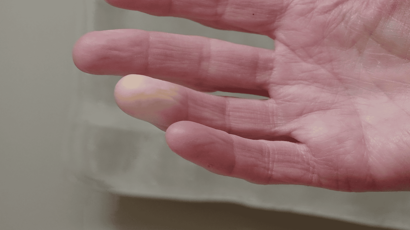 Fenômeno de Raynaud | Dr. Leonardo Pacheco | Angiologista