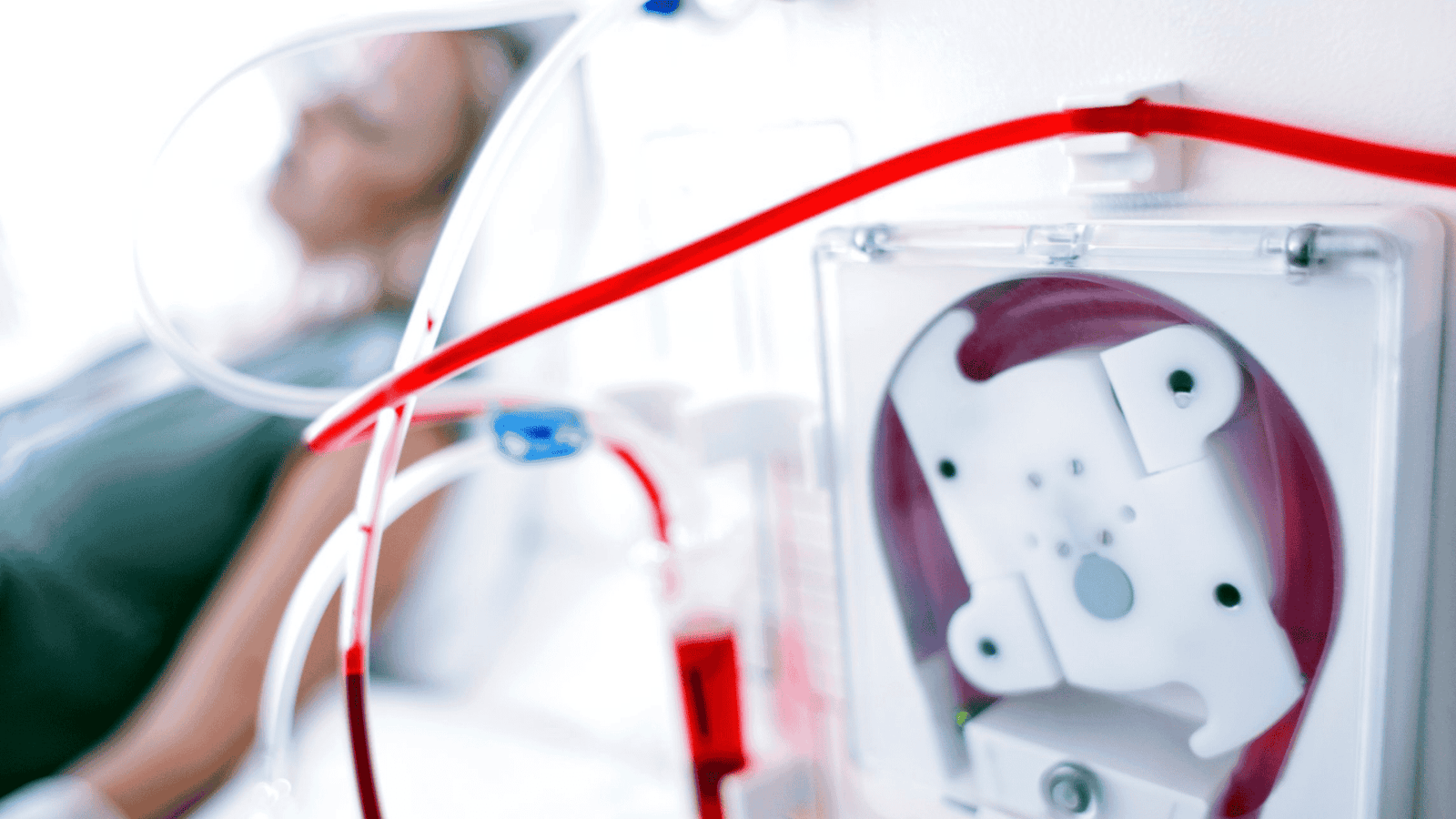 Fístula Arteriovenosa para Hemodiálise | Dr. Leonardo Pacheco | Angiologista