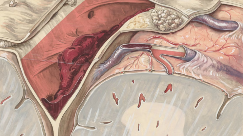 Doença Arterial Periférica DAP | Dr. Leonardo Pacheco | Angiologista