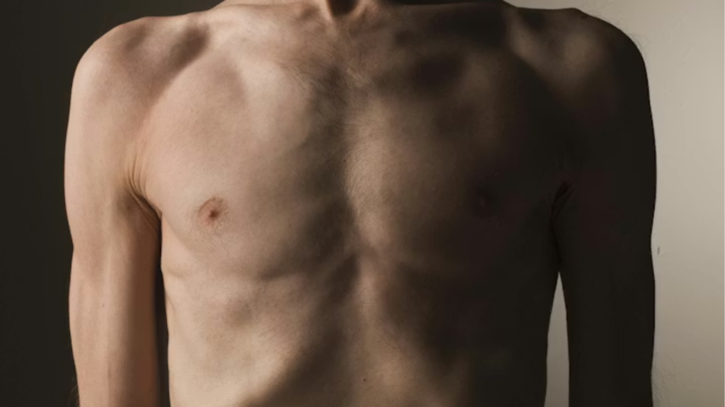 Doenças Vasculares em Pessoas Magras | Dr. Leonardo Pacheco | Angiologista