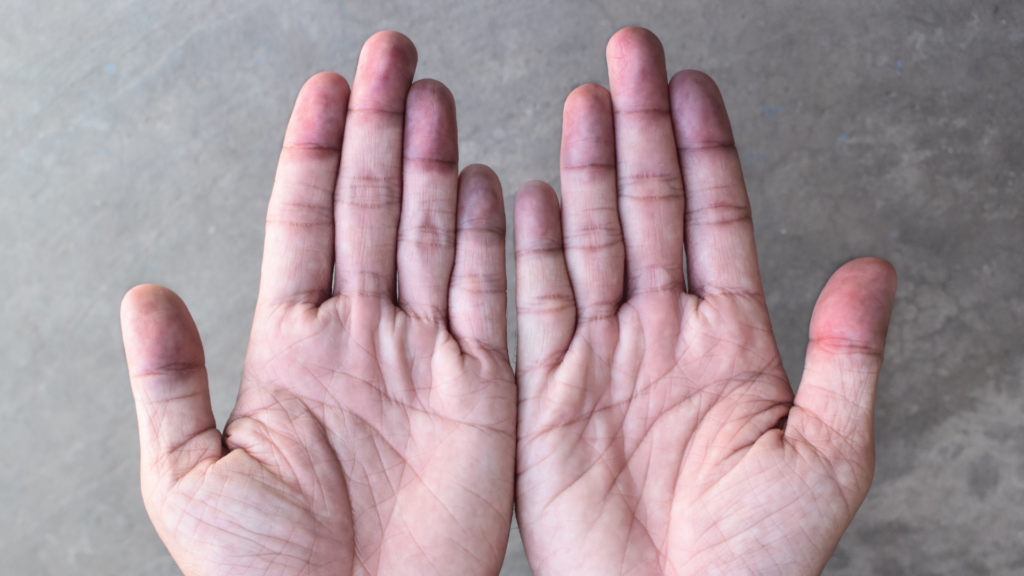 6 Fatos Sobre Acrocianose_ Quando Mãos e Pés Ficam Permanentemente Azulados | Dr. Leonardo Pacheco