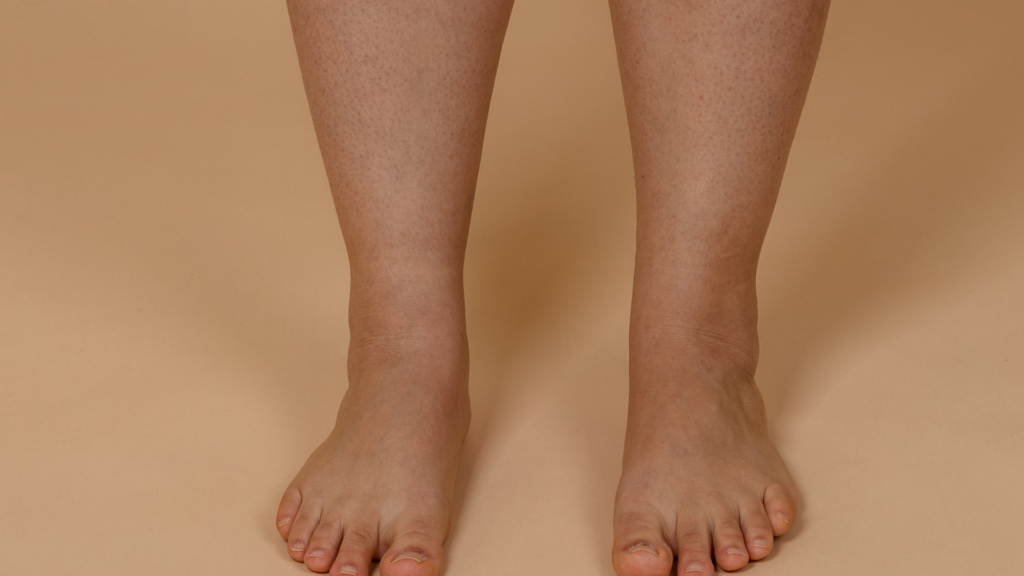 7 Sintomas da Linfangite Causas e Tratamento da Inflamação | Dr. Leonardo Pacheco
