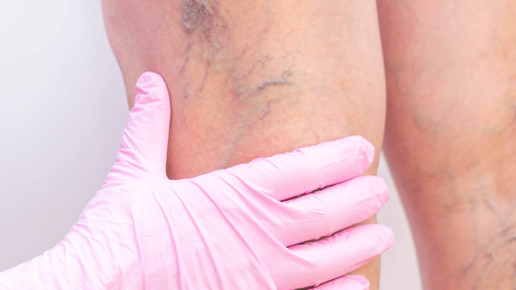 7 Vantagens da Escleroterapia com Espuma para Tratar Varizes | Dr. Leonardo Pacheco