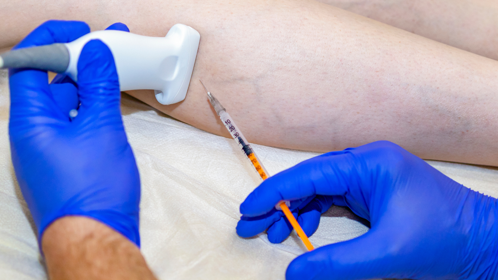 Escleroterapia Líquida: Como Funciona o Tratamento de Vasinhos | Dr. Leonardo Pacheco